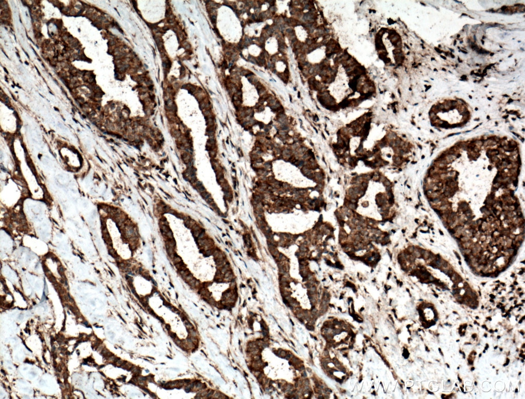 Immunohistochemistry (IHC) staining of human breast cancer tissue using TOMM6 Polyclonal antibody (16689-1-AP)