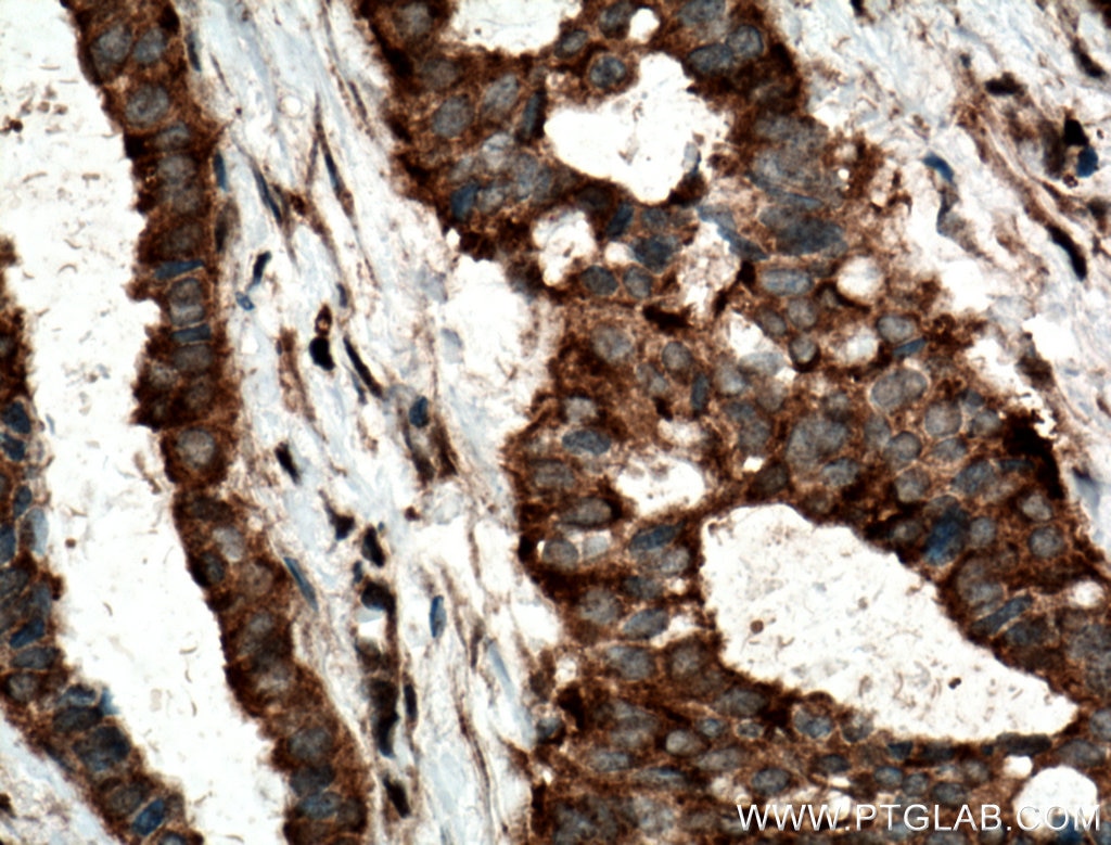 Immunohistochemistry (IHC) staining of human breast cancer tissue using TOMM6 Polyclonal antibody (16689-1-AP)