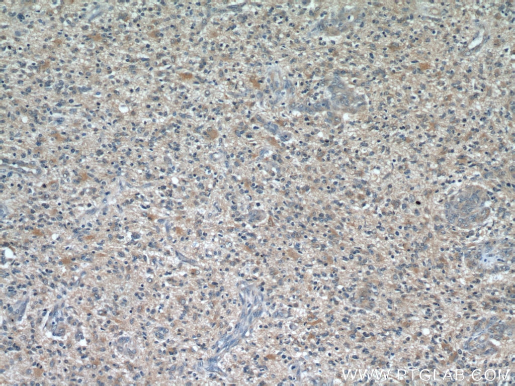 IHC staining of human gliomas using 15071-1-AP