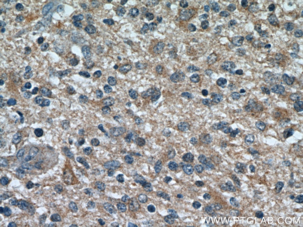 IHC staining of human gliomas using 15071-1-AP