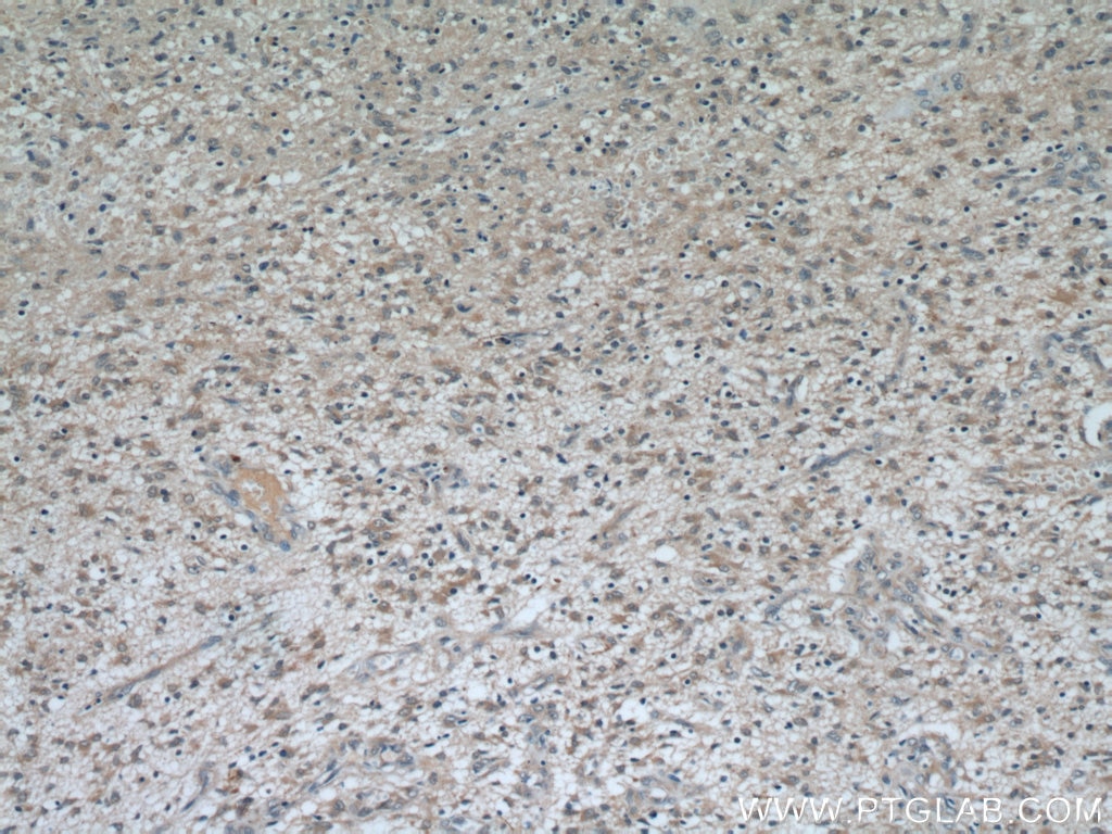 Immunohistochemistry (IHC) staining of human gliomas tissue using TOMM7 Polyclonal antibody (15071-1-AP)