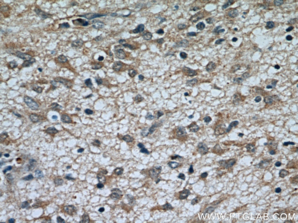 Immunohistochemistry (IHC) staining of human gliomas tissue using TOMM7 Polyclonal antibody (15071-1-AP)
