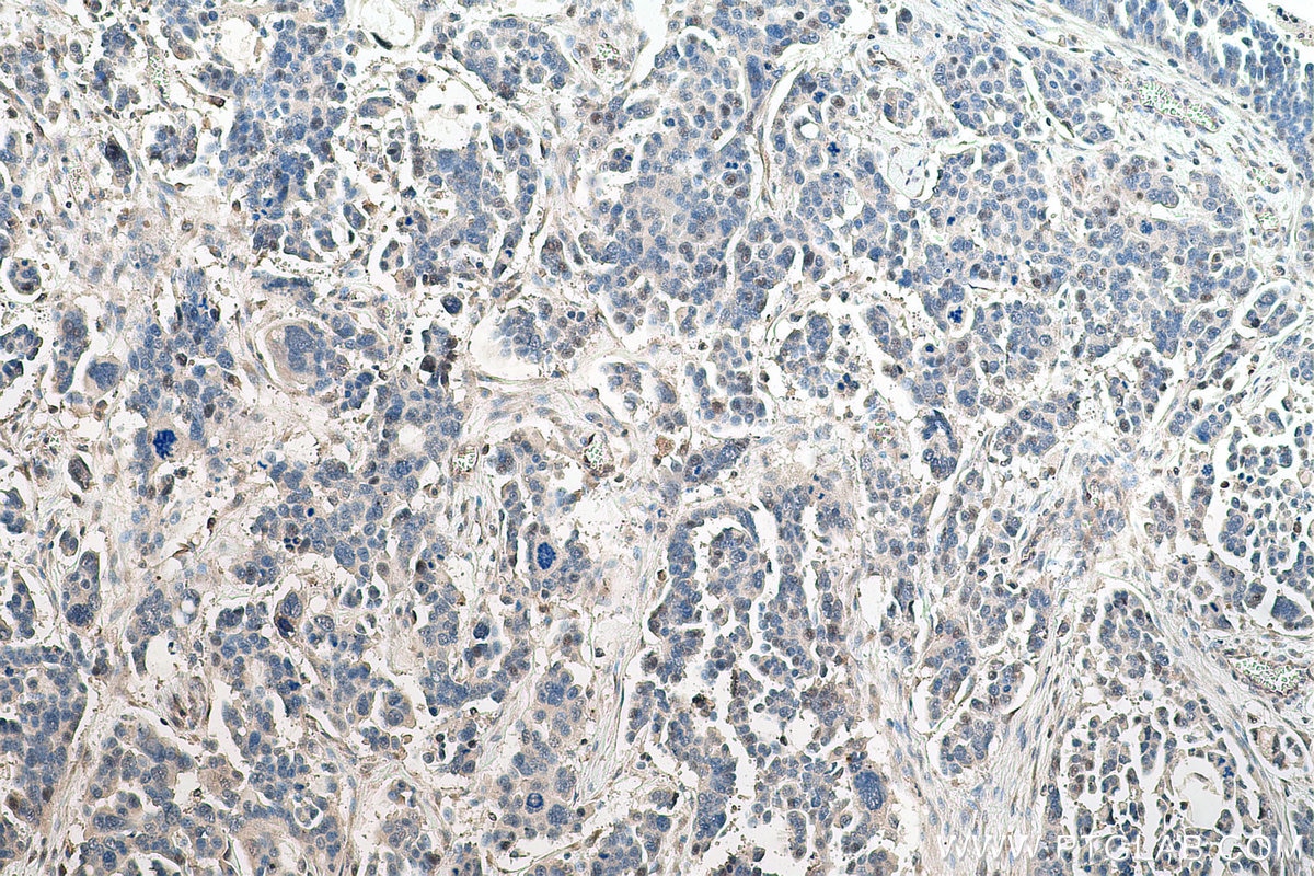 Immunohistochemistry (IHC) staining of human colon cancer tissue using TOP1 Polyclonal antibody (20705-1-AP)