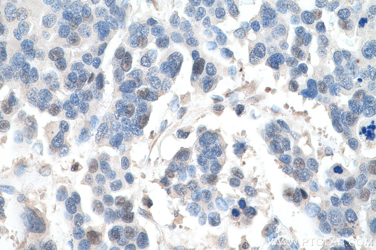 Immunohistochemistry (IHC) staining of human colon cancer tissue using TOP1 Polyclonal antibody (20705-1-AP)