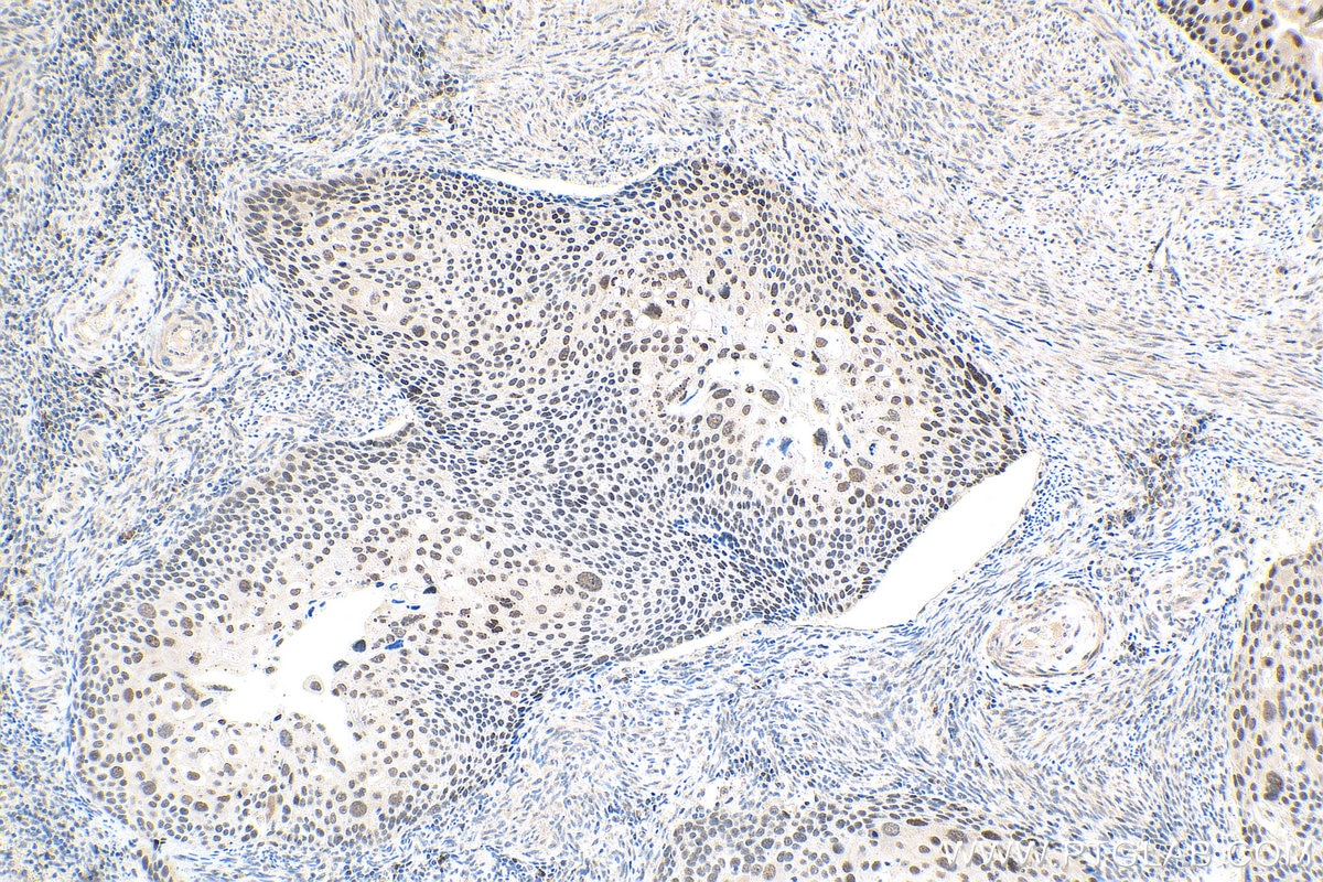 Immunohistochemistry (IHC) staining of human cervical cancer tissue using TOP1 Polyclonal antibody (20705-1-AP)