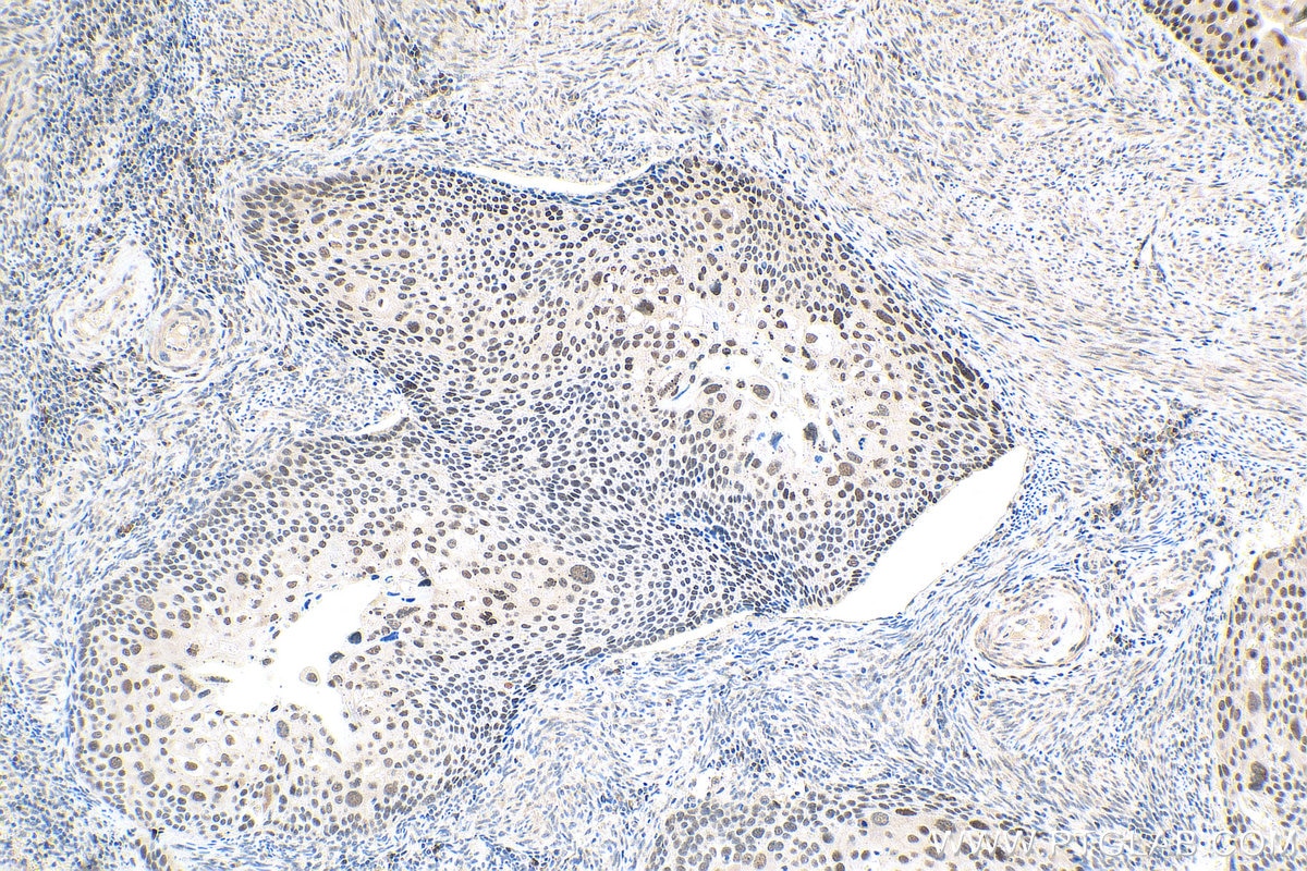 IHC staining of human cervical cancer using 20705-1-AP