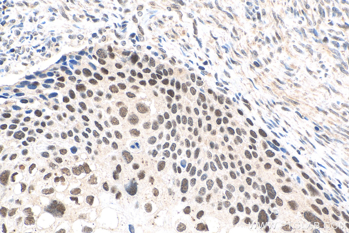 Immunohistochemistry (IHC) staining of human cervical cancer tissue using TOP1 Polyclonal antibody (20705-1-AP)