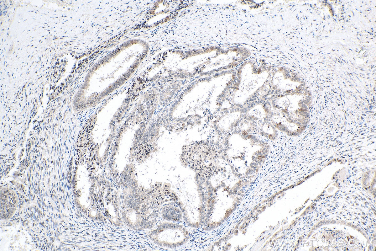 Immunohistochemistry (IHC) staining of human ovary tumor tissue using TOP1 Polyclonal antibody (20705-1-AP)