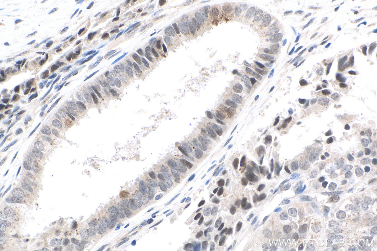 Immunohistochemistry (IHC) staining of human ovary tumor tissue using TOP1 Polyclonal antibody (20705-1-AP)