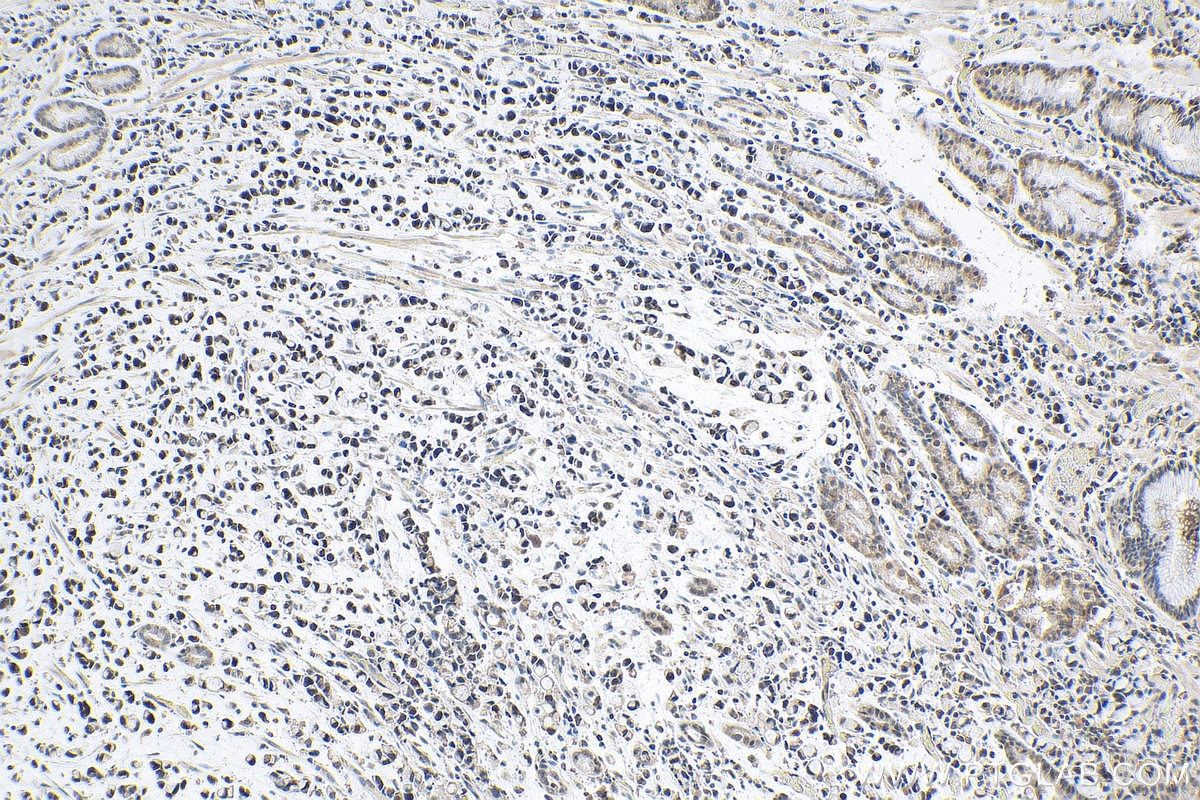 Immunohistochemistry (IHC) staining of human stomach cancer tissue using TOP1 Polyclonal antibody (20705-1-AP)
