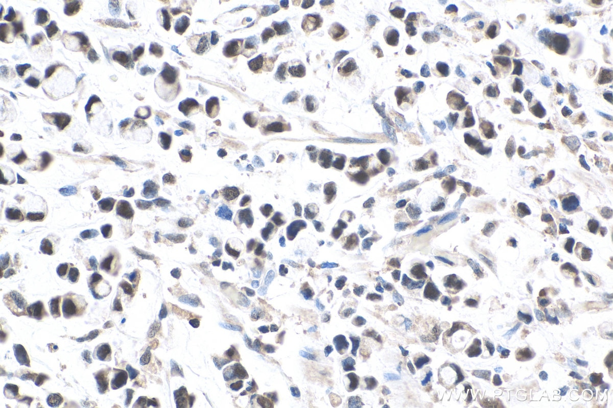 Immunohistochemistry (IHC) staining of human stomach cancer tissue using TOP1 Polyclonal antibody (20705-1-AP)