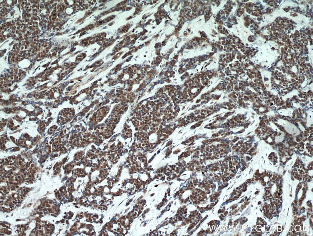 Immunohistochemistry (IHC) staining of human cervical cancer tissue using TOP1 Polyclonal antibody (20705-1-AP)