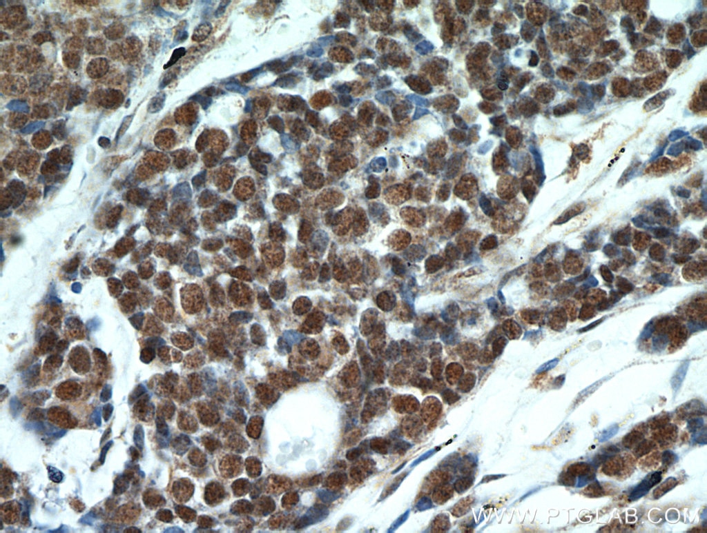 Immunohistochemistry (IHC) staining of human cervical cancer tissue using TOP1 Polyclonal antibody (20705-1-AP)