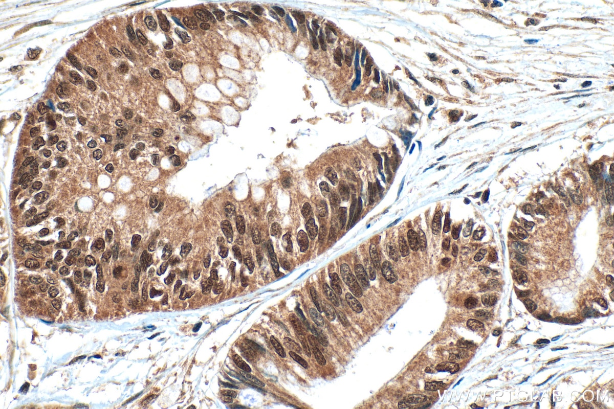 Immunohistochemistry (IHC) staining of human pancreas cancer tissue using TOP2A Polyclonal antibody (24641-1-AP)