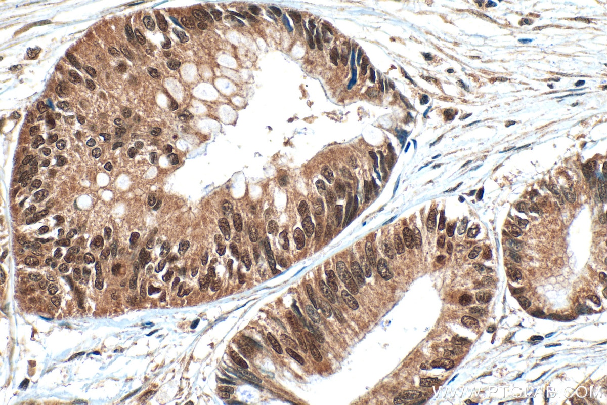 IHC staining of human pancreas cancer using 24641-1-AP