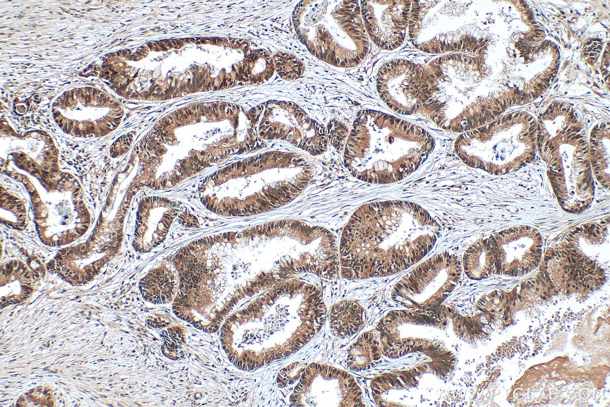 IHC staining of human pancreas cancer using 24641-1-AP