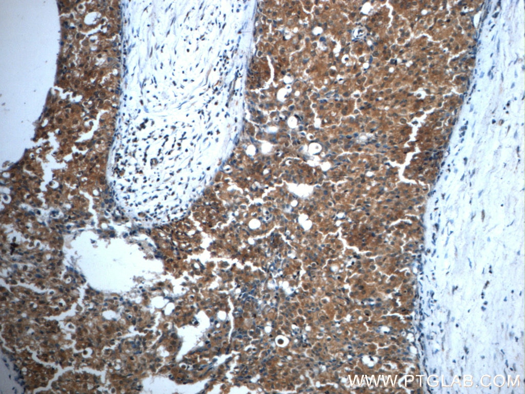 Immunohistochemistry (IHC) staining of human breast cancer tissue using TOP2A Polyclonal antibody (24641-1-AP)