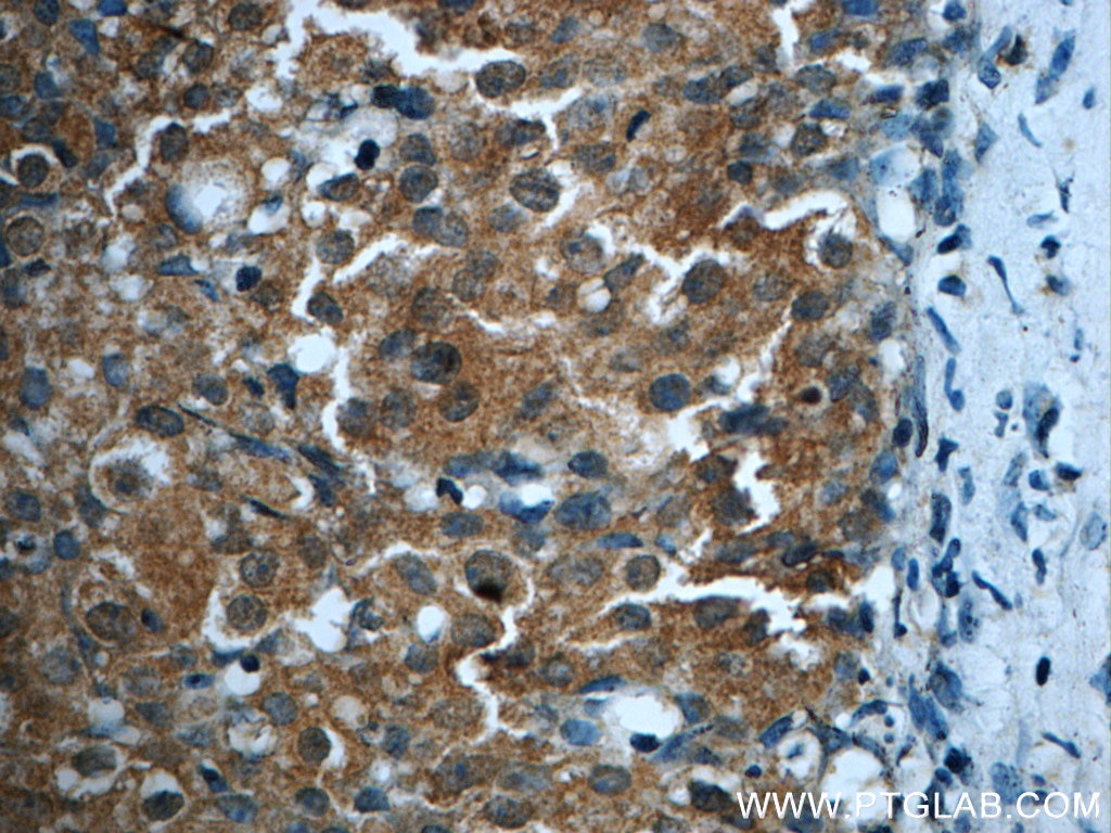 IHC staining of human breast cancer using 24641-1-AP