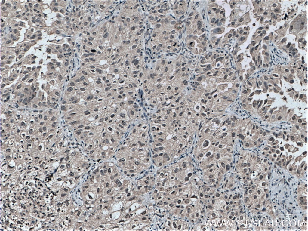 Immunohistochemistry (IHC) staining of human lung cancer tissue using TOP2A Monoclonal antibody (66541-1-Ig)