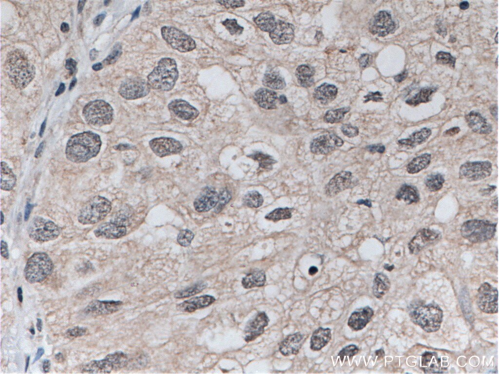 Immunohistochemistry (IHC) staining of human lung cancer tissue using TOP2A Monoclonal antibody (66541-1-Ig)