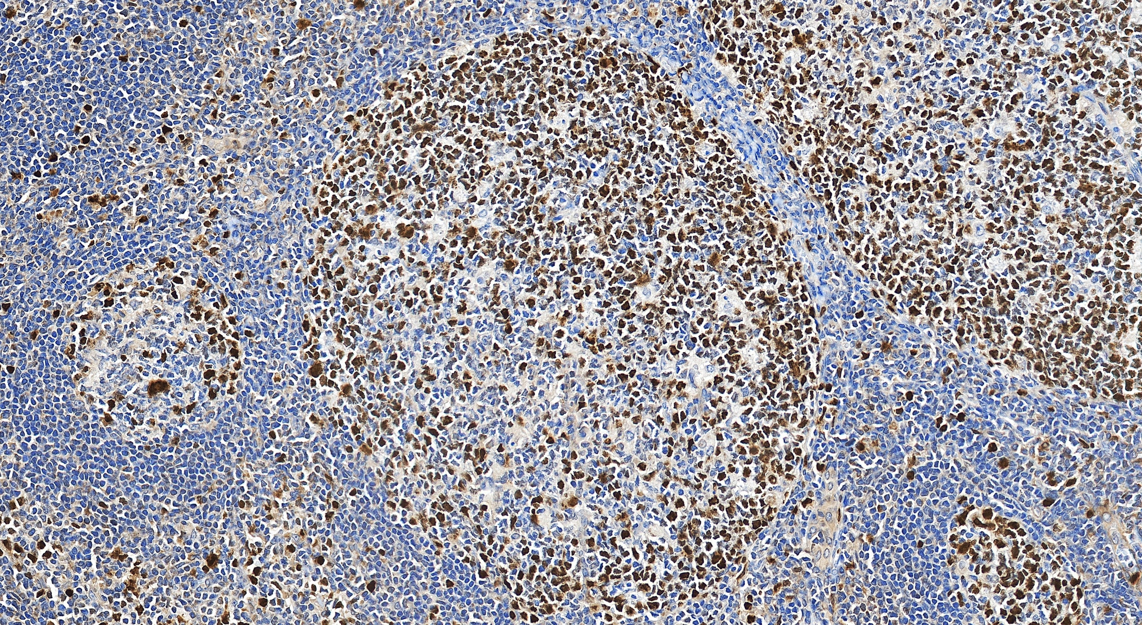 Immunohistochemical analysis of paraffin-embedded human tonsillitis tissue slide using 82738-4-RR (TOP2A antibody) at dilution of 1:4000 (under 20x lens). Heat mediated antigen retrieval with Tris-EDTA buffer (pH 9.0). Immunohistochemistry (IHC) staining of human tonsillitis tissue using TOP2A Recombinant monoclonal antibody (82738-4-RR)