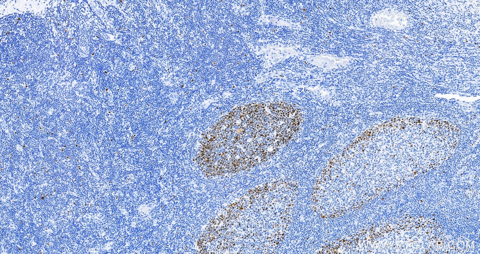 IHC staining of human tonsillitis using 82738-10-RR Immunohistochemistry (IHC) staining of human tonsillitis tissue using TOP2A-Specific Recombinant monoclonal antibody (82738-10-RR)