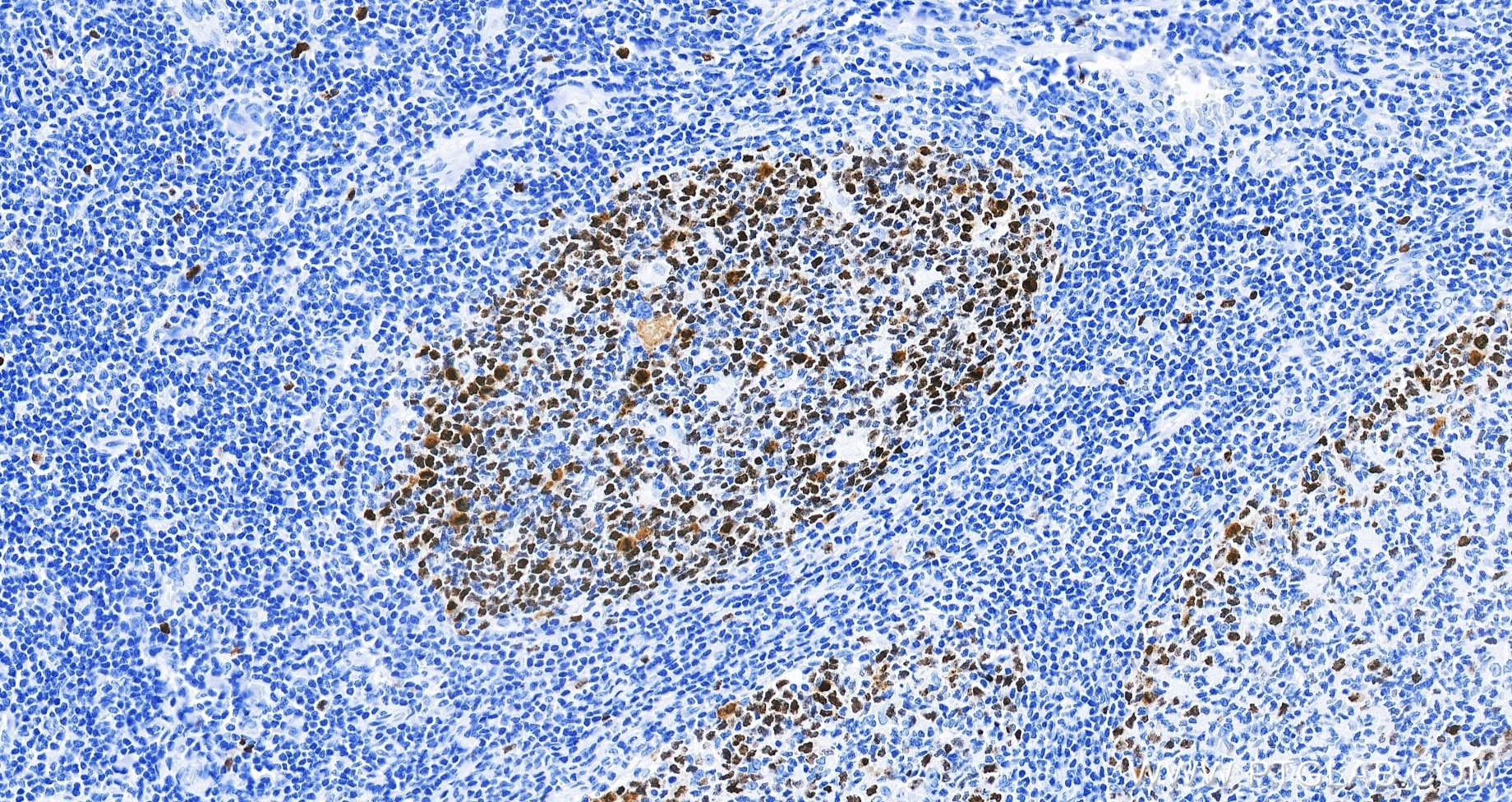IHC staining of human tonsillitis using 82738-10-RR Immunohistochemistry (IHC) staining of human tonsillitis tissue using TOP2A-Specific Recombinant monoclonal antibody (82738-10-RR)