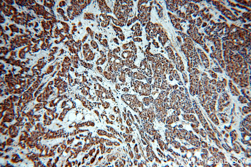 Immunohistochemistry (IHC) staining of human cervical cancer tissue using TOP2B Polyclonal antibody (20549-1-AP)