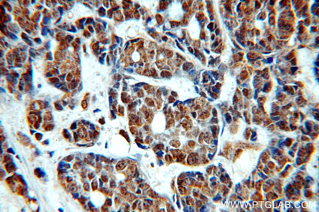 Immunohistochemistry (IHC) staining of human cervical cancer tissue using TOP2B Polyclonal antibody (20549-1-AP)