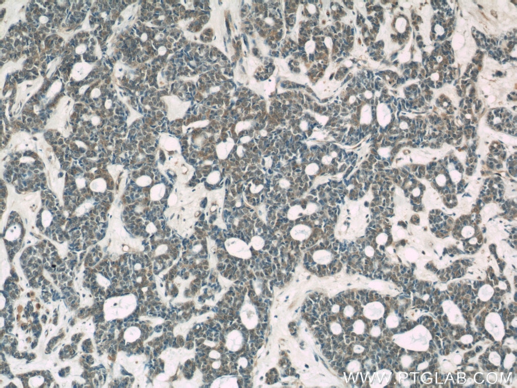 Immunohistochemistry (IHC) staining of human cervical cancer tissue using TOP2B Polyclonal antibody (20549-1-AP)