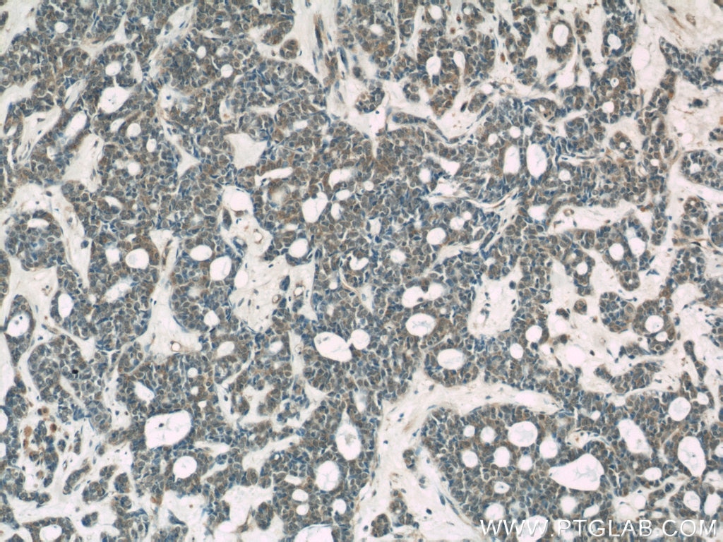 IHC staining of human cervical cancer using 20549-1-AP