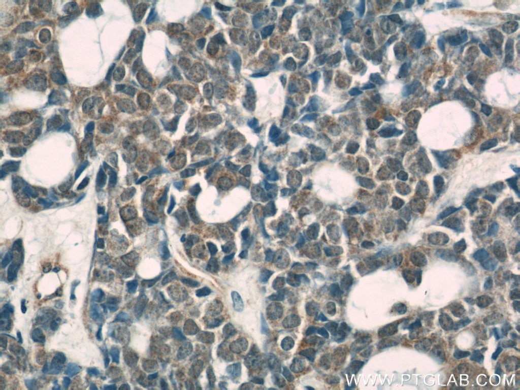 Immunohistochemistry (IHC) staining of human cervical cancer tissue using TOP2B Polyclonal antibody (20549-1-AP)