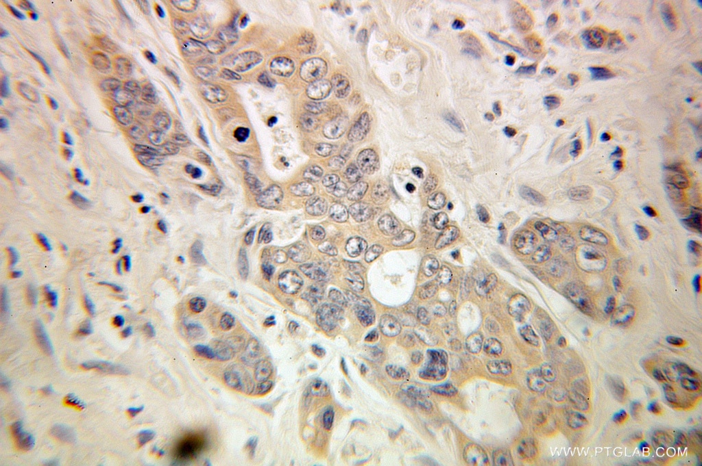 IHC staining of human colon cancer using 10296-1-AP