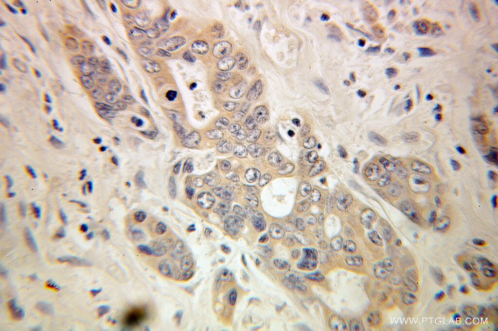 Immunohistochemistry (IHC) staining of human colon cancer tissue using Torsin A Polyclonal antibody (10296-1-AP)