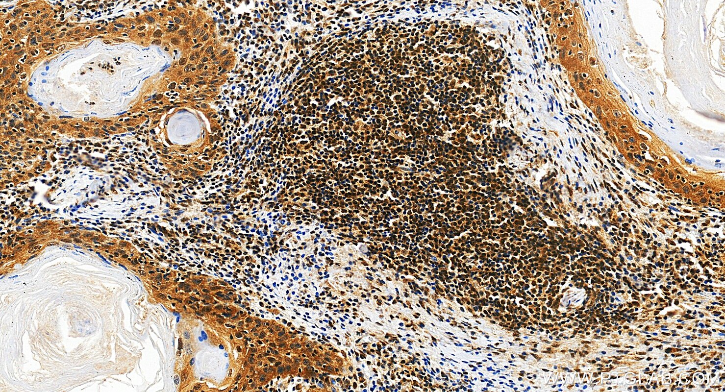 IHC staining of human skin cancer using RMX00047 Immunohistochemistry (IHC) staining of human skin cancer tissue using Multi-rAb® TORC2 Multi-Recombinant antibody (RMX00047)