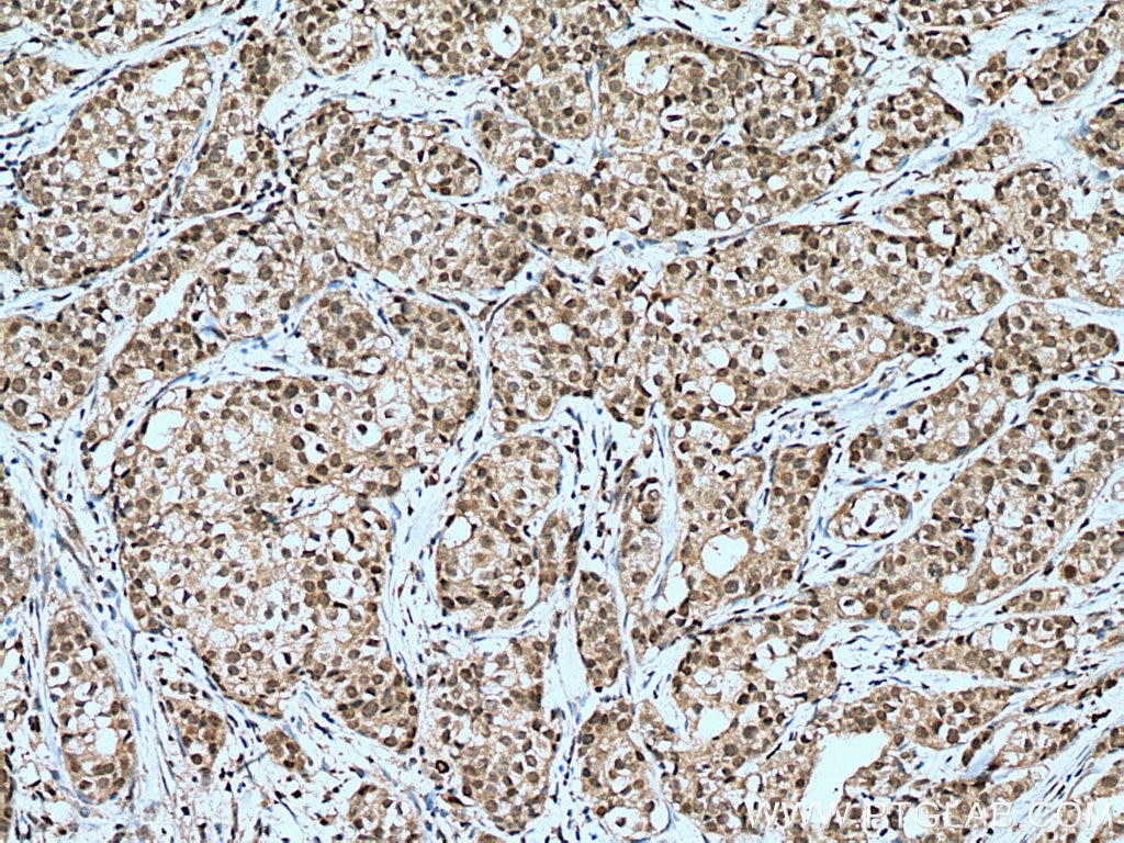 Immunohistochemistry (IHC) staining of human breast cancer tissue using TOX2 Polyclonal antibody (21162-1-AP)