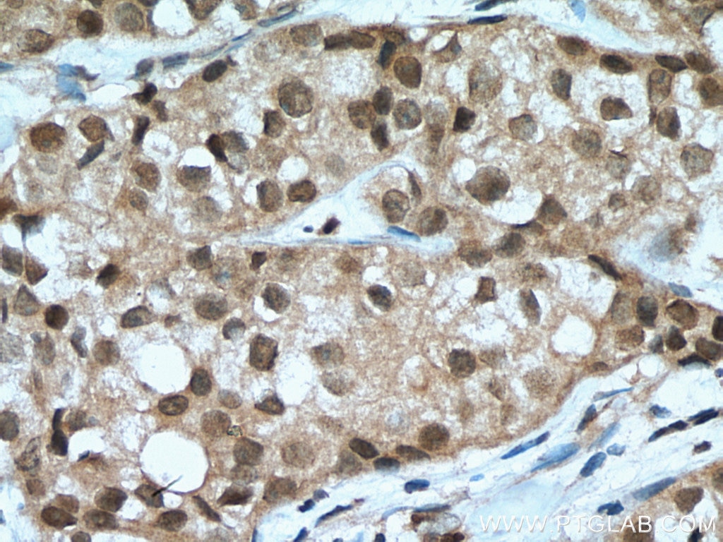 Immunohistochemistry (IHC) staining of human breast cancer tissue using TOX2 Polyclonal antibody (21162-1-AP)