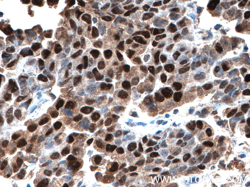 Immunohistochemistry (IHC) staining of human prostate cancer tissue using P53 Polyclonal antibody (21891-1-AP)