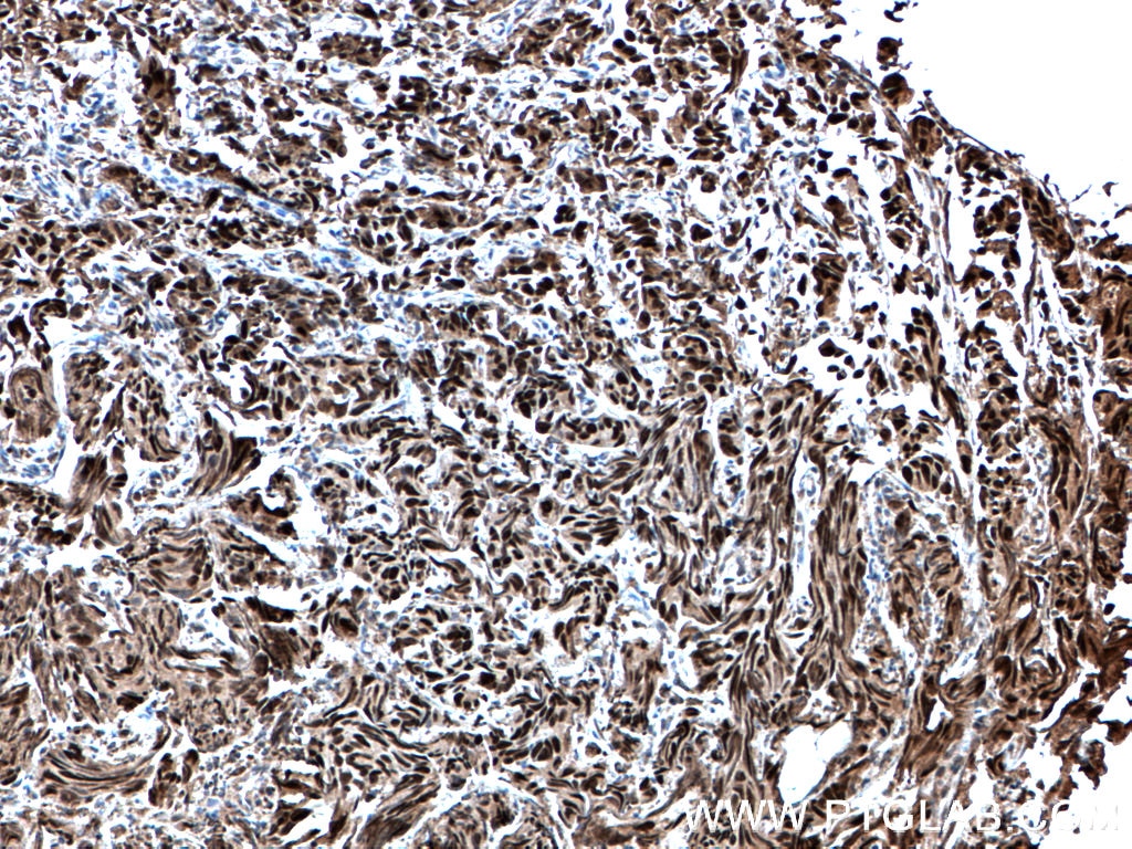 Immunohistochemistry (IHC) staining of human prostate cancer tissue using P53 Polyclonal antibody (21891-1-AP)