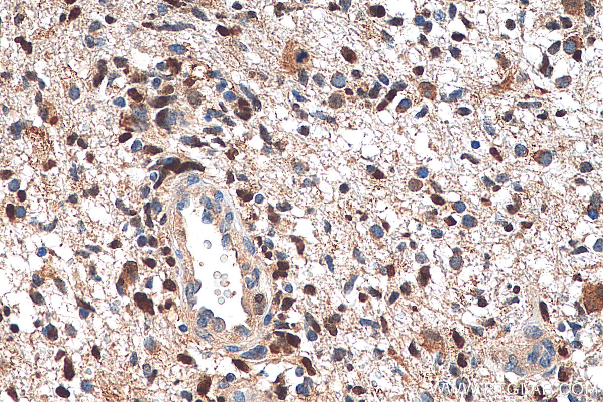 Immunohistochemistry (IHC) staining of human gliomas tissue using P53 Polyclonal antibody (21891-1-AP)