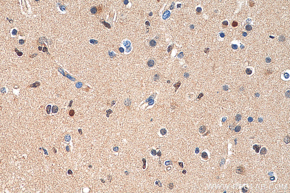 IHC staining of human gliomas using 21891-1-AP