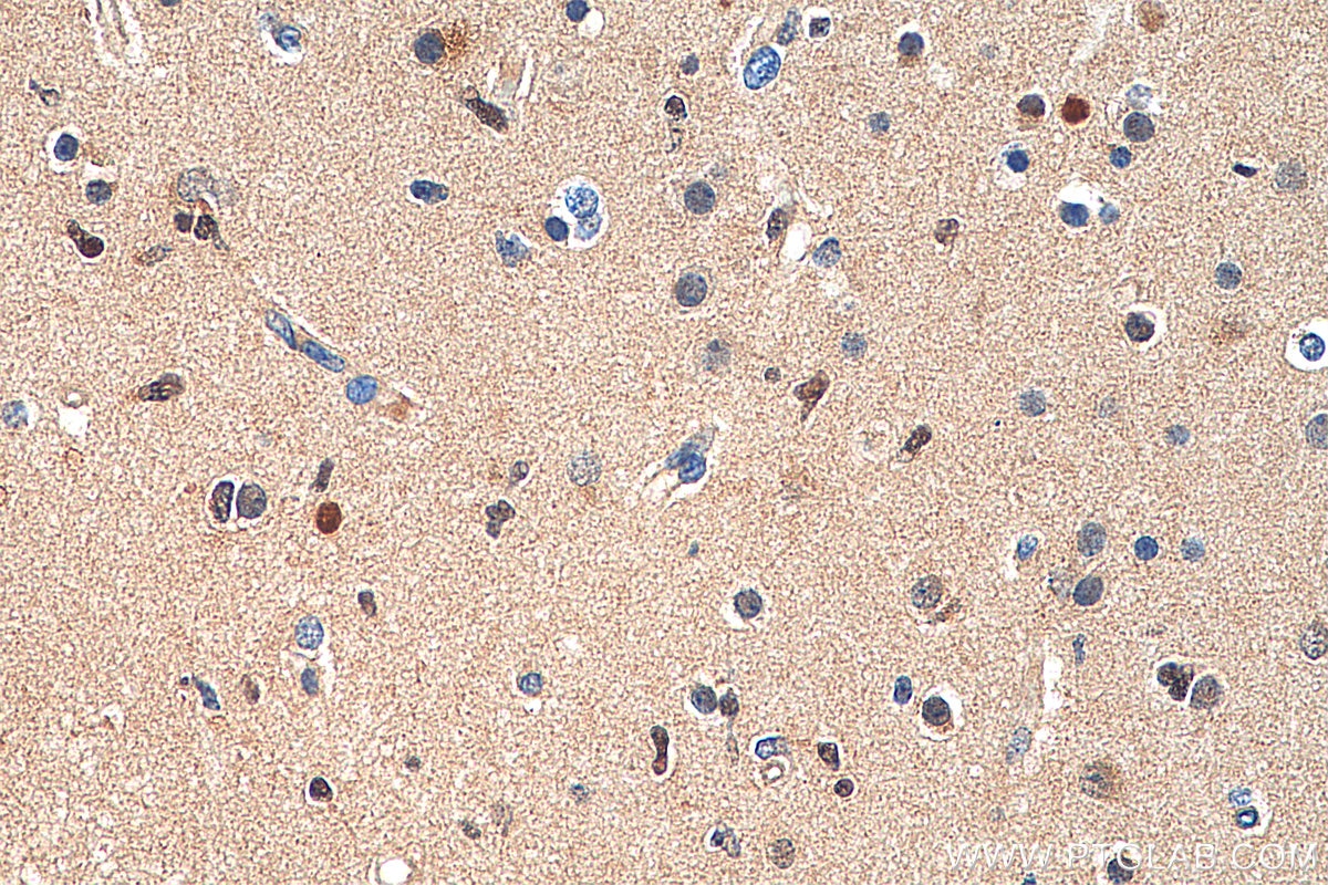 Immunohistochemistry (IHC) staining of human gliomas tissue using P53 Polyclonal antibody (21891-1-AP)