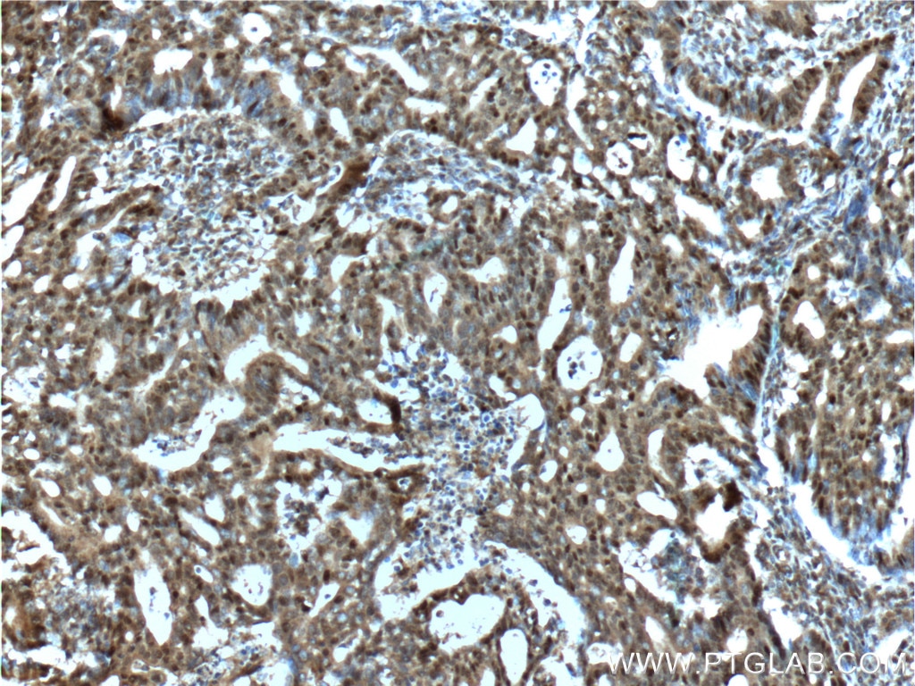 Immunohistochemistry (IHC) staining of human endometrial cancer tissue using P53 Polyclonal antibody (21891-1-AP)