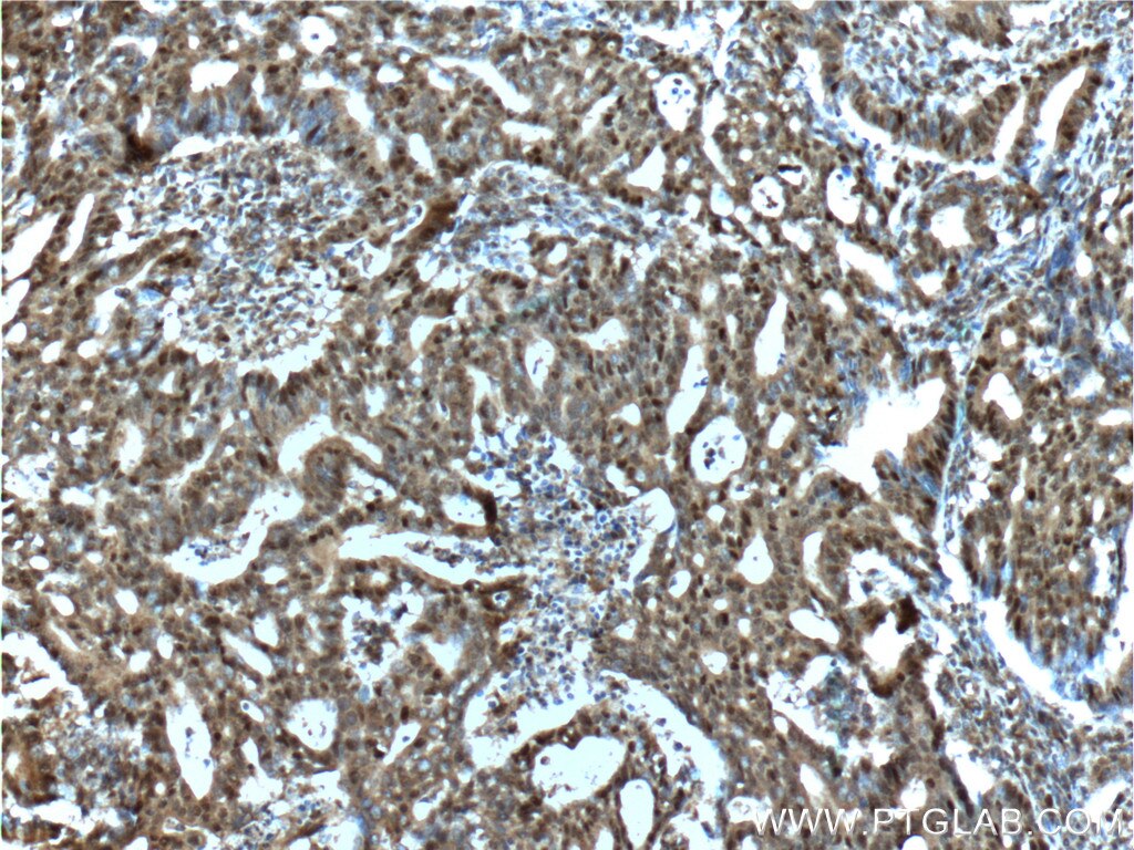 IHC staining of human endometrial cancer using 21891-1-AP