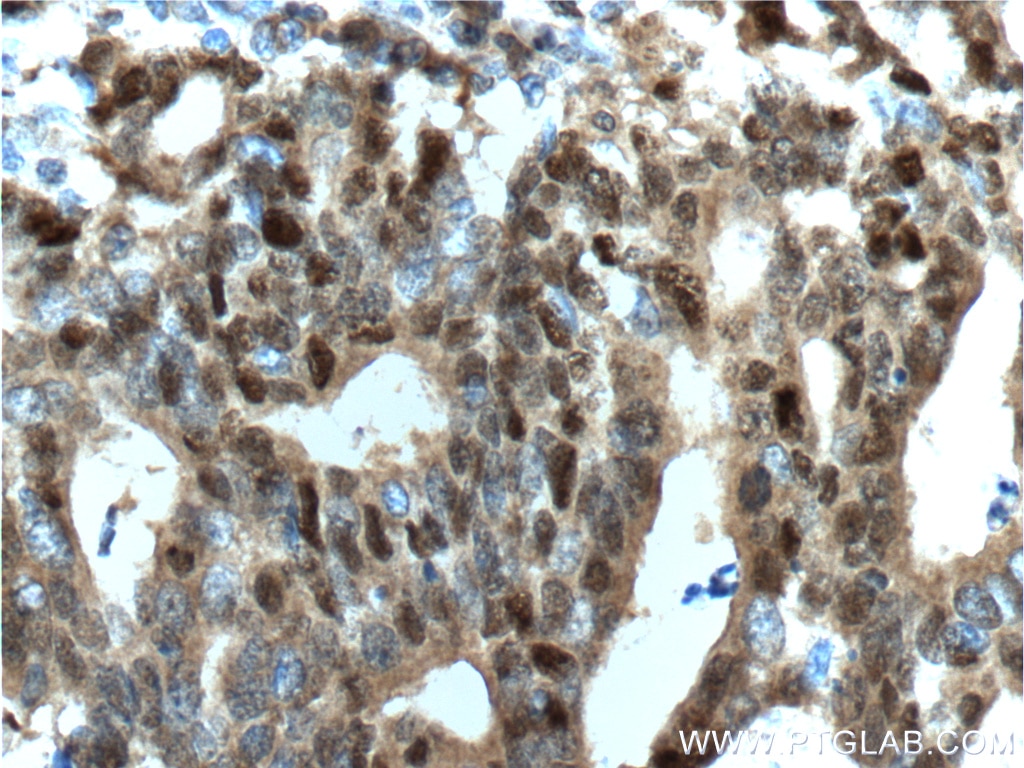 Immunohistochemistry (IHC) staining of human endometrial cancer tissue using P53 Polyclonal antibody (21891-1-AP)