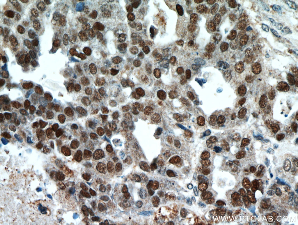 Immunohistochemistry (IHC) staining of human ovary tumor tissue using P53 Polyclonal antibody (21891-1-AP)