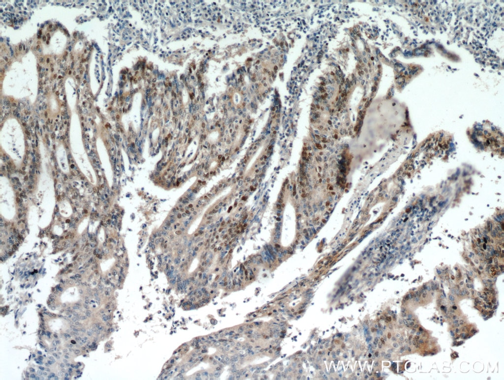 Immunohistochemistry (IHC) staining of human endometrial cancer tissue using P53 Polyclonal antibody (21891-1-AP)