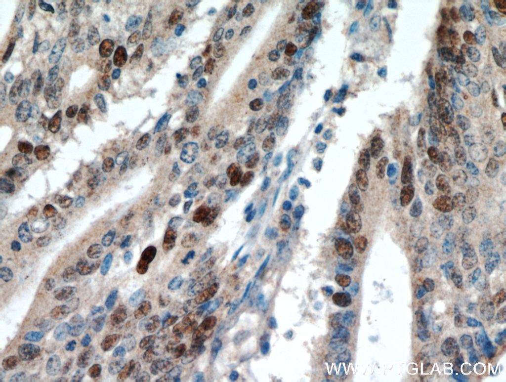 Immunohistochemistry (IHC) staining of human endometrial cancer tissue using P53 Polyclonal antibody (21891-1-AP)