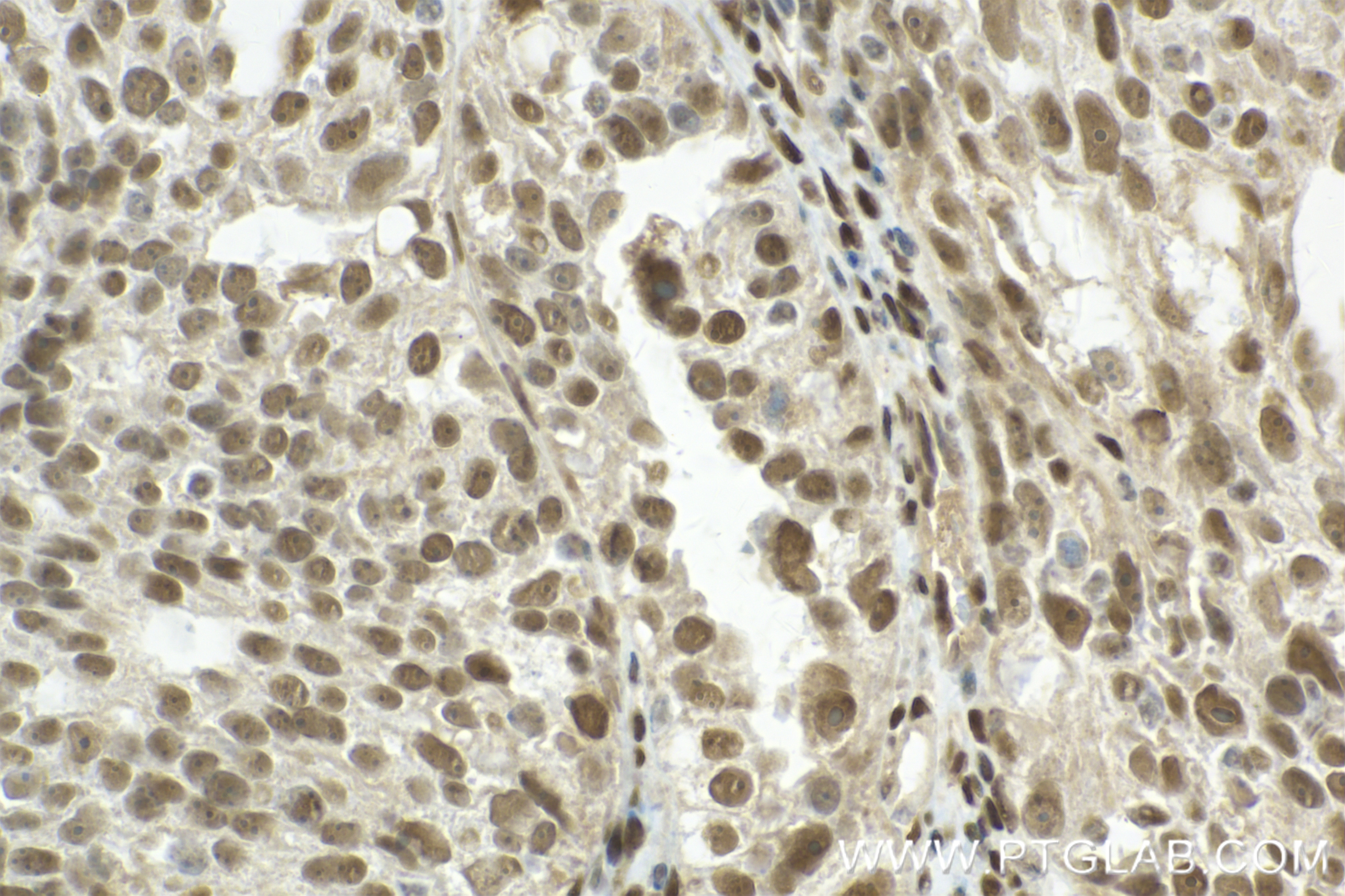 Immunohistochemistry (IHC) staining of human ovary cancer tissue using TP53BP1-Specific Recombinant antibody (83809-1-RR)
