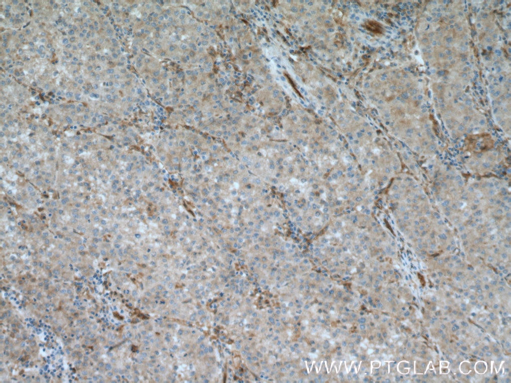 Immunohistochemistry (IHC) staining of human liver cancer tissue using PIG3 Polyclonal antibody (14828-1-AP)